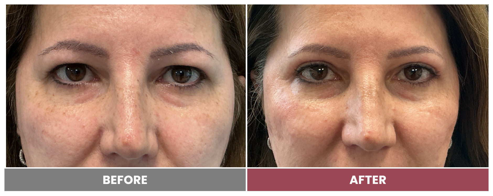 Upper Blepharoplasty - Case ana-bulzomi